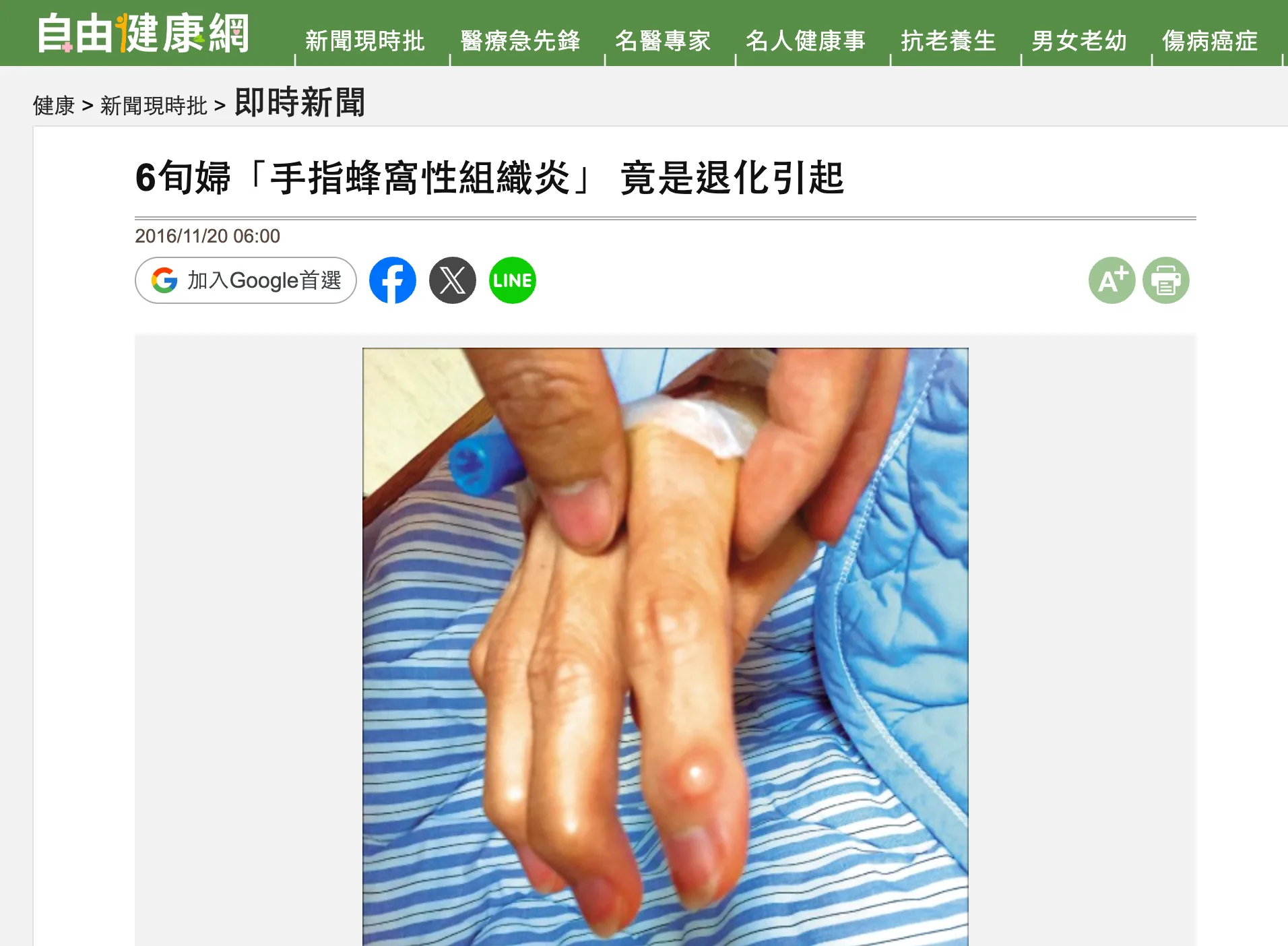 媒體報導:手指蜂窩性組織炎,源頭竟是黏液性囊腫封面