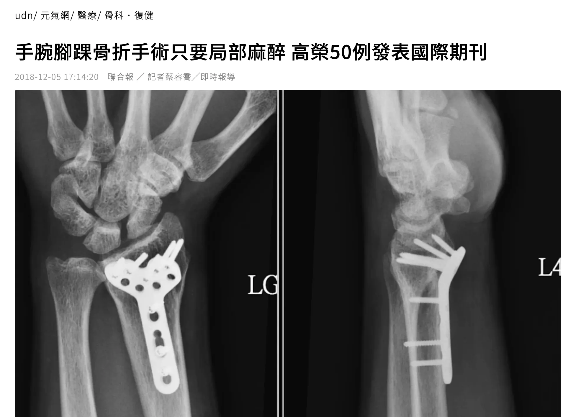 高雄榮總記者會發表WALANT完全清醒手術領先國際成果封面
