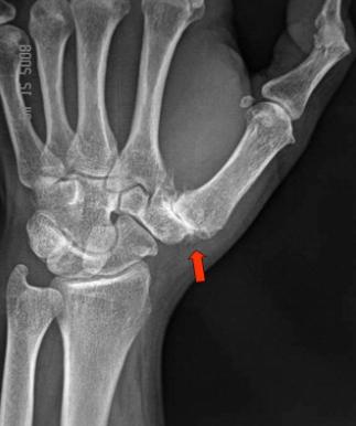 X光可以見到關節磨損滑脫(Ref:https://www.orthobullets.com/hand/6054/basilar-thumb-arthritis)