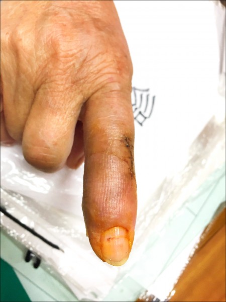 局部皮瓣覆蓋皮膚缺損後約3週,外觀恢復正常