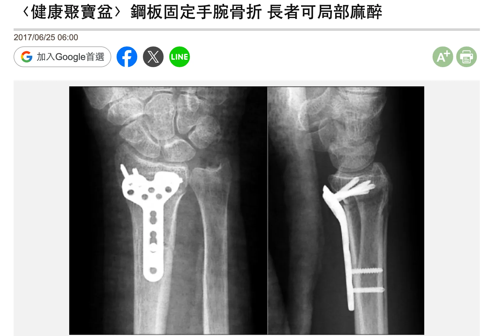 媒體報導：鋼板固定手腕骨折 長者可局部麻醉封面
