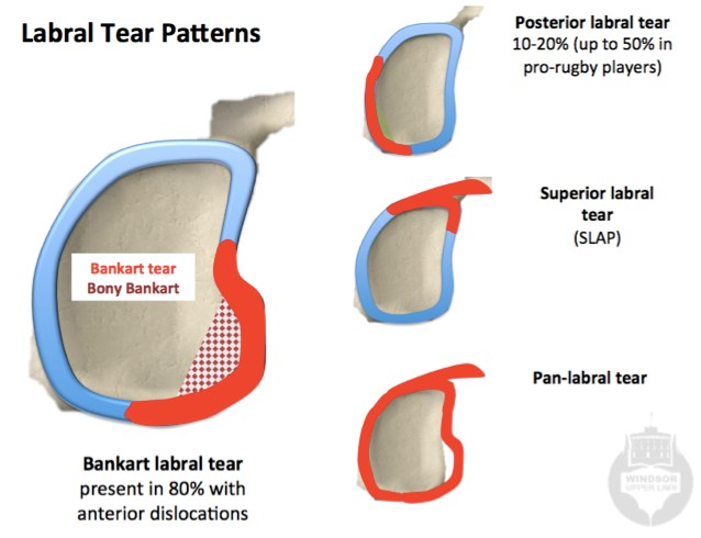 常見到的關節盂唇破裂是Bankart及SLAP (Ref : http://www.windsorupperlimb.com/conditions/shoulder-conditions/shoulder-dislocation-instabilty-and-labral-tears)
