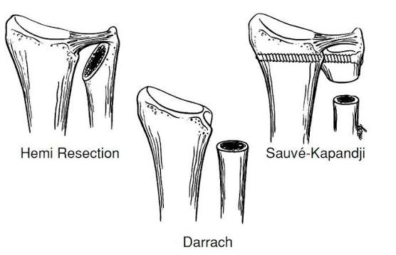 常見的幾種手術方式 (Ref : https://www.facebook.com/thearmdoc/posts/surgical-interventions-on-the-distal-radioulnar-joint-hemiresection-arthroplasty/1586531000182625/)