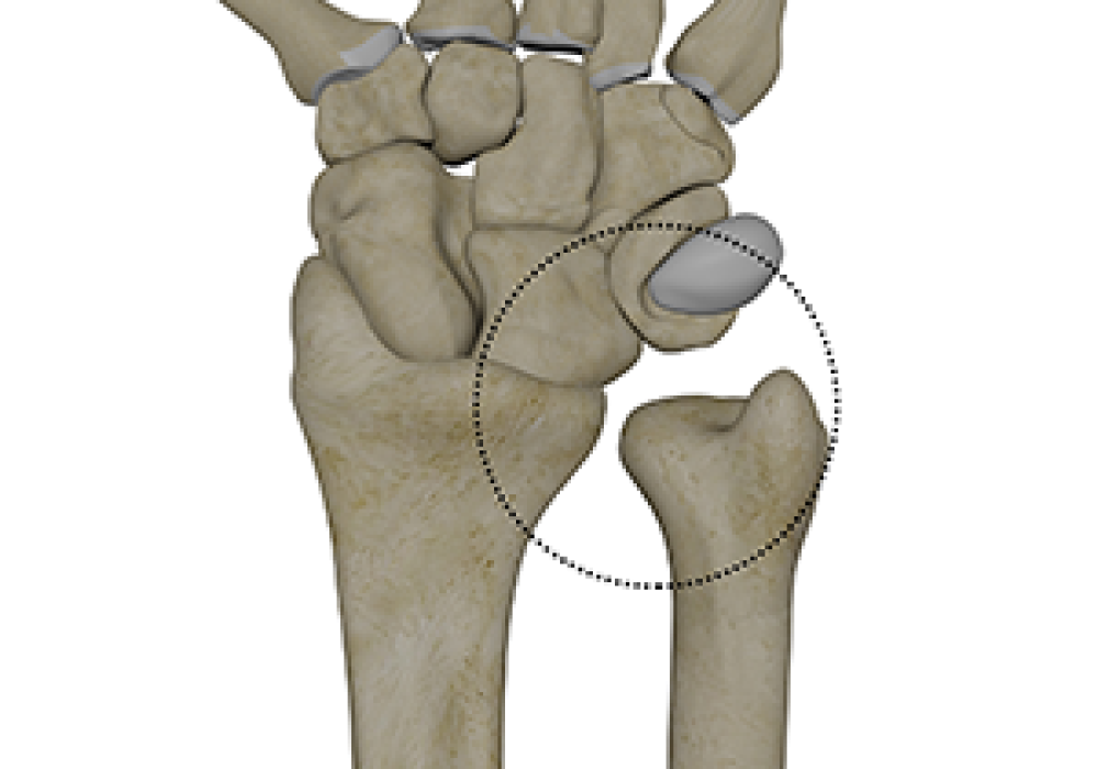 圈圈處即為遠端橈尺關節 (Ref : https://handandnervesurgery.com/druj-instabilities-dislocations/)